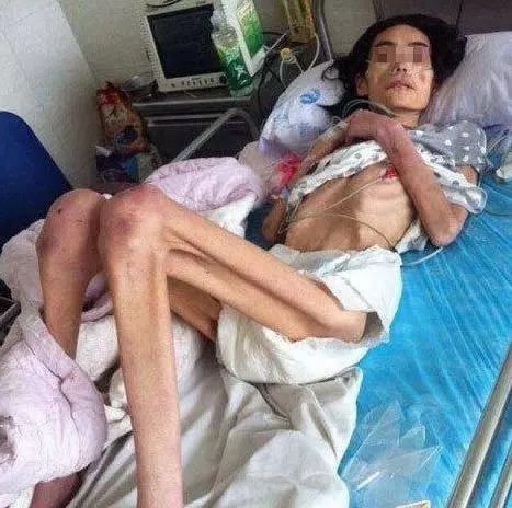 為了維護出軌兒子,婆婆將漂亮兒媳,虐待餓成40斤骷髏...!原本模樣長得很美阿...可憐