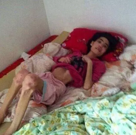 為了維護出軌兒子,婆婆將漂亮兒媳,虐待餓成40斤骷髏...!原本模樣長得很美阿...可憐