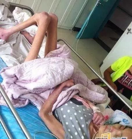 為了維護出軌兒子,婆婆將漂亮兒媳,虐待餓成40斤骷髏...!原本模樣長得很美阿...可憐