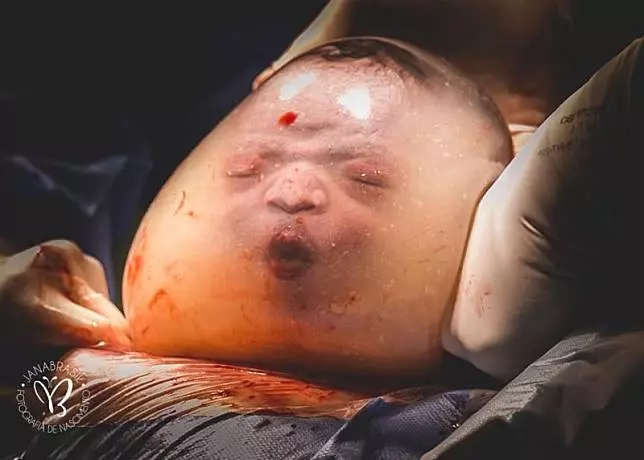 罕見畫面!羊水未破就出生 男嬰照片震驚世界...