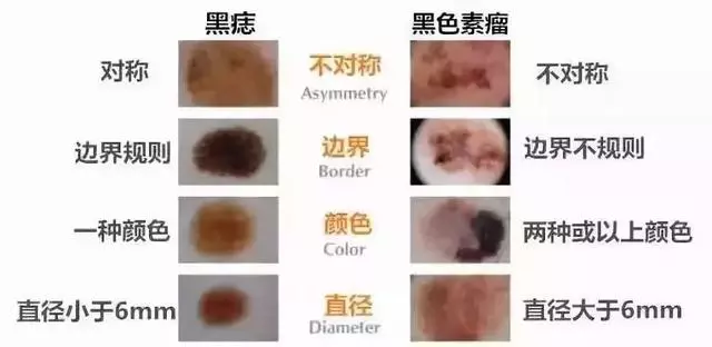 「痣」的直徑超這個數可能是瘤!5招教你辨別痣和瘤