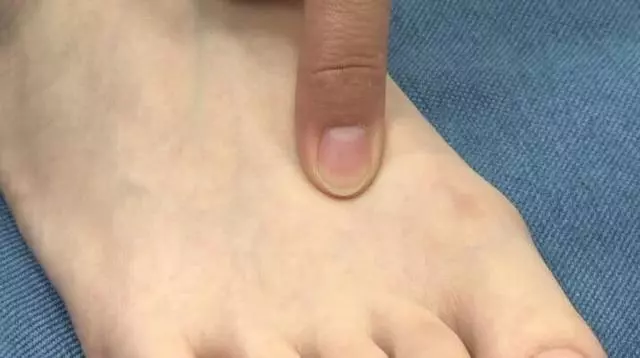 脂肪肝作為一種較常見的疾病,該怎樣預防?支一招——刺激太衝穴