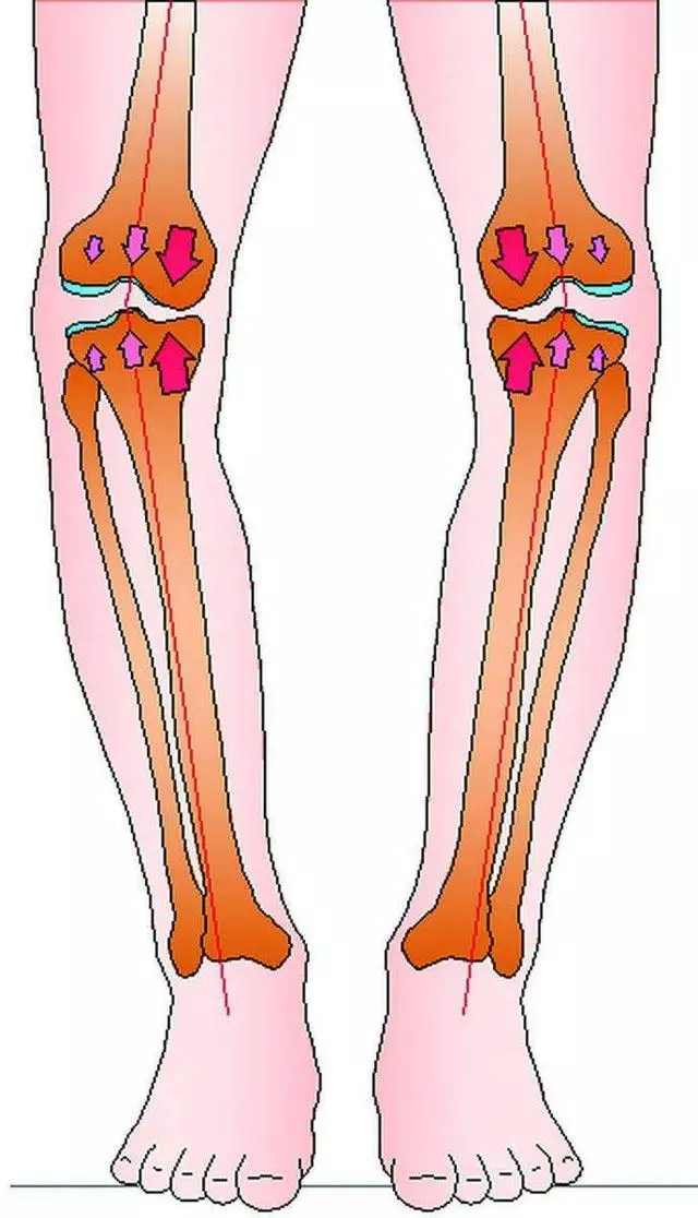 O型腿、膝蓋痛?8秒蹲姿有效矯正O型腿