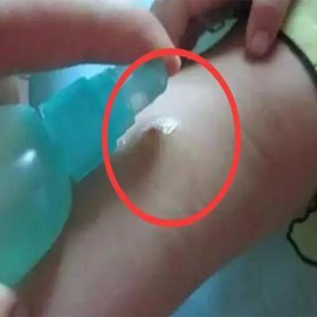 蚊子咬了腫一包奇癢難忍?越抓越癢!教你止癢方法,60秒後止癢去痕!