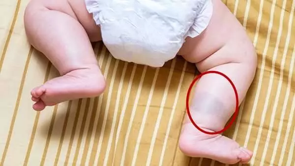 亞洲小孩身上出現的「瘀青胎記」,原來不是「床母」做的記號!家長都來看看吧!