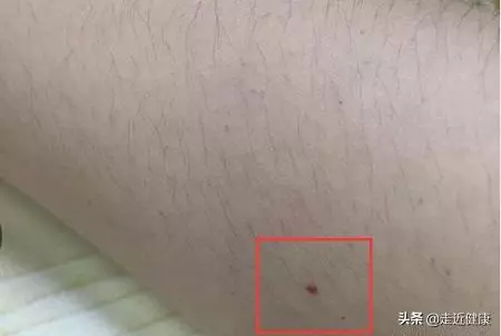 熬夜肝火旺,口乾口苦,毒素積累?3個方法降火排毒,疏肝解鬱!