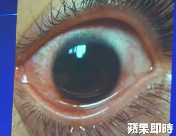 常看高亮度熒幕手機 女子眼角膜被「烤破」500個洞 | 中國報 China Press