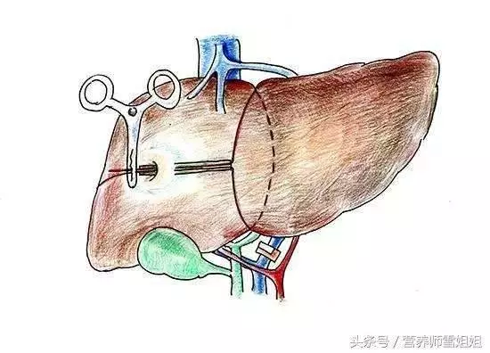 以下5個表現,說明你的肝臟已經受損了!肝臟受損,謹記飯後「一坐一閉」,睡前「三不要」