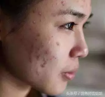 以下5個表現,說明你的肝臟已經受損了!肝臟受損,謹記飯後「一坐一閉」,睡前「三不要」