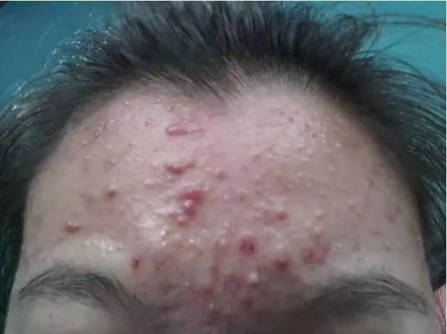 以下5個表現,說明你的肝臟已經受損了!肝臟受損,謹記飯後「一坐一閉」,睡前「三不要」