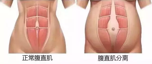 生娃後,為什麼媽媽們都喊「腰痛」?若你以為是「麻醉針」惹的禍,那就錯了!