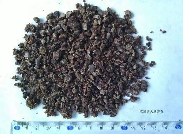 他總是腰痛,醫院檢查出420顆腎結石。原因竟然是我們常吃的這種食物!甚至連兩歲孩子都患有腎結石,一定要看!