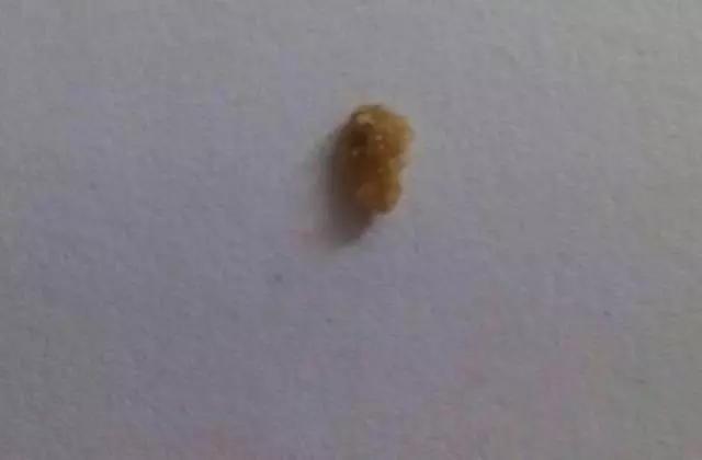 他總是腰痛,醫院檢查出420顆腎結石。原因竟然是我們常吃的這種食物!甚至連兩歲孩子都患有腎結石,一定要看!