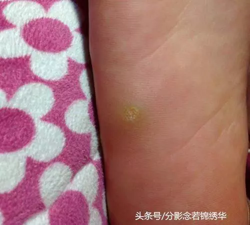 手腳長雞眼真難受啊!教你兩招,輕松去除不留痕!