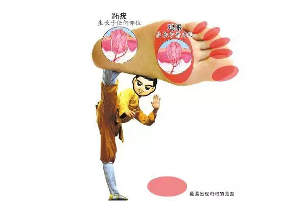 手腳長雞眼真難受啊!教你兩招,輕松去除不留痕!