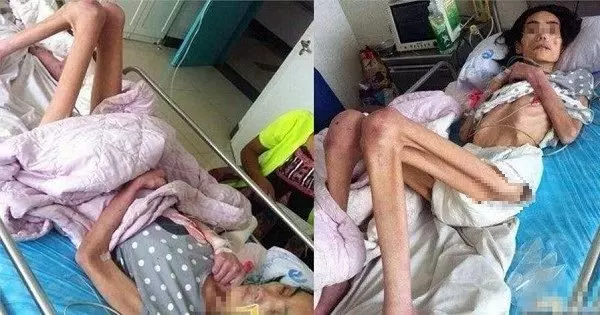 為了維護出軌兒子,婆婆將漂亮兒媳,虐待餓成40斤骷髏…!原本模樣長得很美阿…可憐