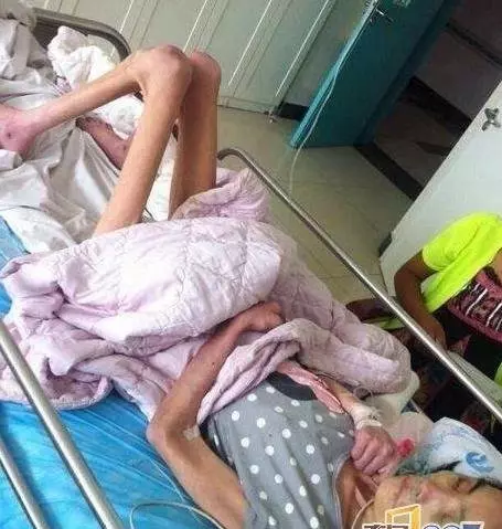 為了維護出軌兒子,婆婆將漂亮兒媳,虐待餓成40斤骷髏…!原本模樣長得很美阿…可憐