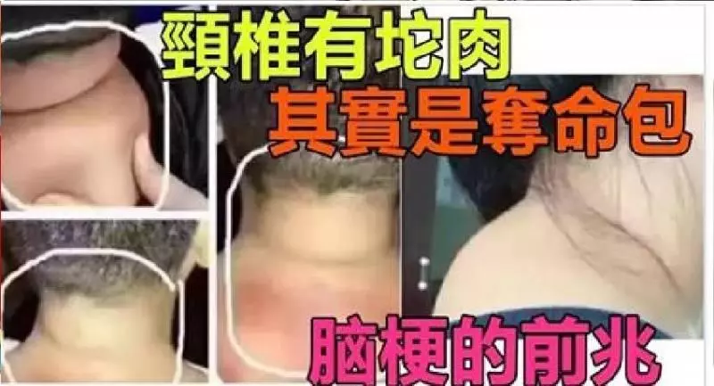 頸椎「有坨肉」號稱「富貴包」，其實是「奪命包」！是「腦梗」的前兆，教你三招解決它！