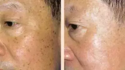 老年斑太多很難消?巧用5個小方法,色斑、老年斑都趕走!