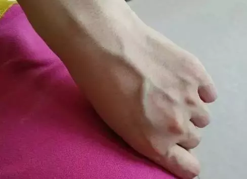 手上青筋越多,說明身體是好是壞?青筋到底是怎麼回事?