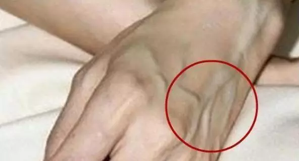 手上青筋越多,說明身體是好是壞?青筋到底是怎麼回事?