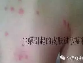 你以為身上的包是蚊子咬的?其實並不是!如果你家有,趕快清理掉!