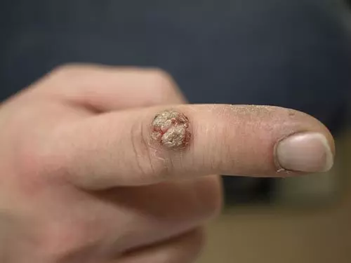 擦個身體長「菜花」 貪方便貪便宜惹禍