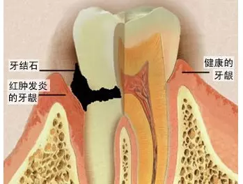 到底要不要定期「洗牙」?專家一句話解開你多年的疑惑!