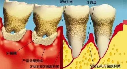 到底要不要定期「洗牙」?專家一句話解開你多年的疑惑!