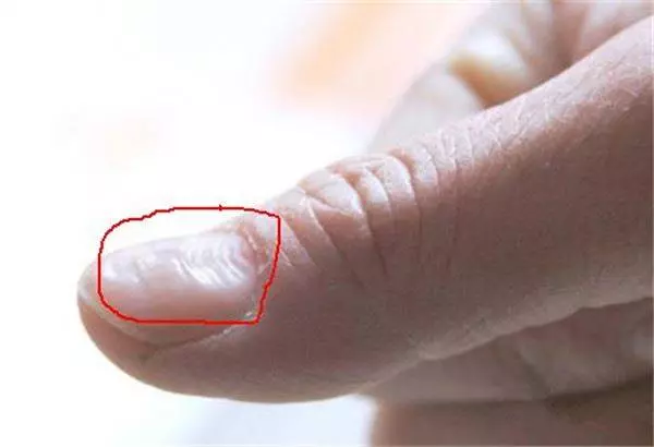 指甲出現這「5種狀況」千萬不要忽視,很可能是身體大病的前兆