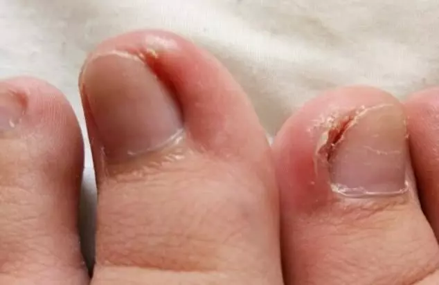 腳趾甲往肉裡長,一碰就疼?教你一招自己解決,不用去醫院找醫生