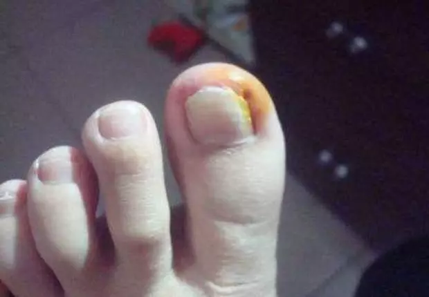 腳趾甲往肉裡長,一碰就疼?教你一招自己解決,不用去醫院找醫生