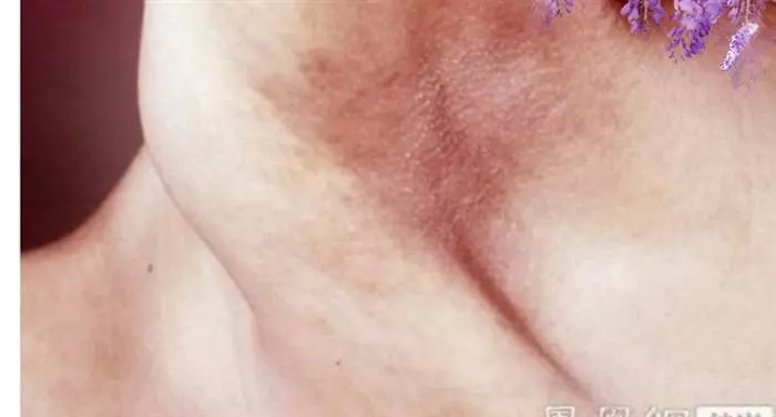 天啊!這個地方如果變黑,你可就要小心了!!可能是癌癥前兆!
