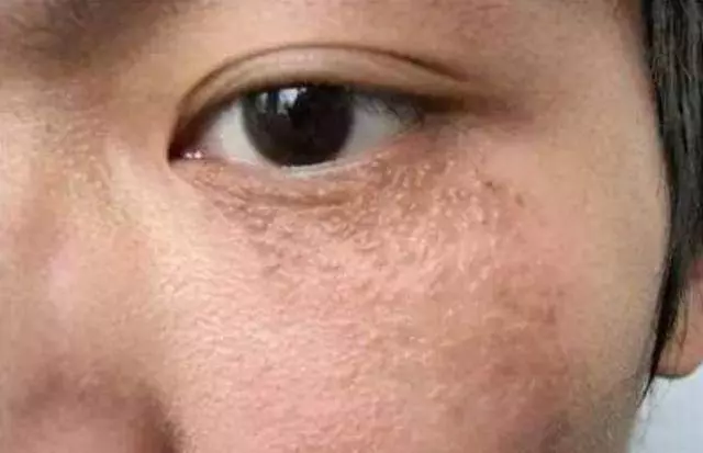 臉上長脂肪粒不要用手擠,教你3個小妙招,就能快速去除脂肪粒! !