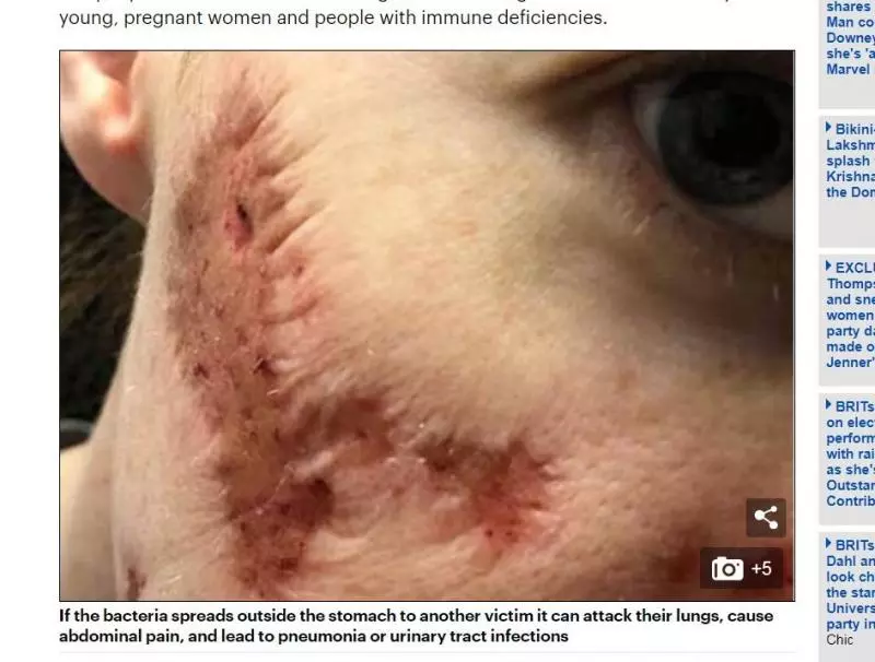 用公廁洗手乳染菌爆長血瘡!她「殭屍上臉」...右半邊現粉褐色坑洞