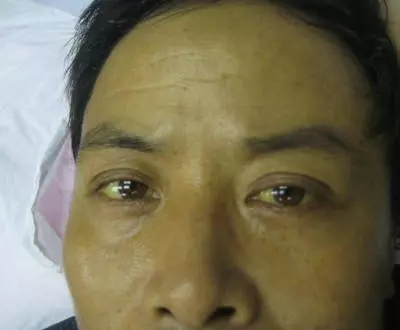 別忽視!「肝癌」的8種徵兆你一定要知道 ! 晚看了後悔一輩子!!