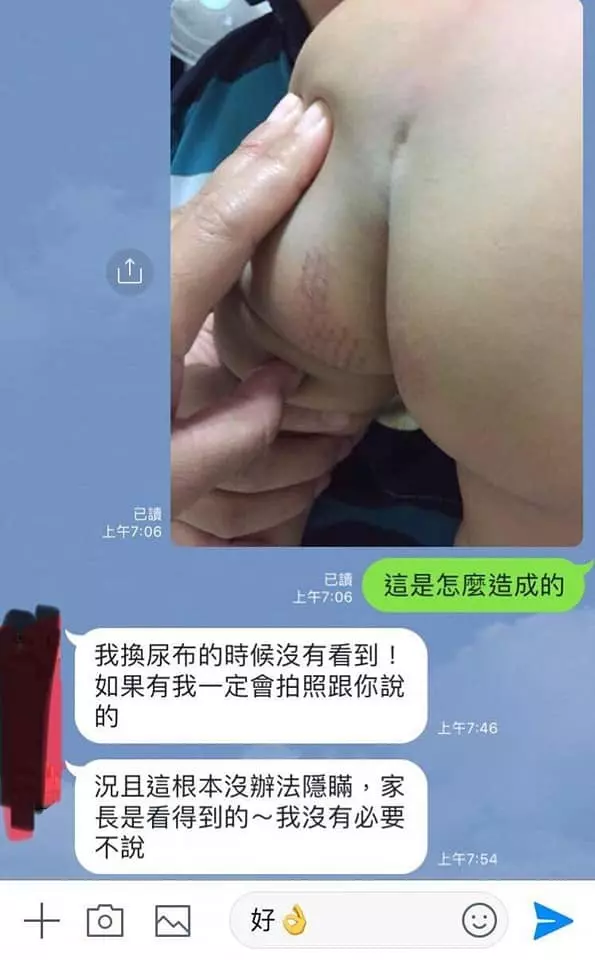 又見狠心保母!吹風機燙1歲男童生殖器、屁股起水泡