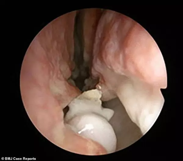 男子鼻孔長牙齒 還會出濁白液體 !