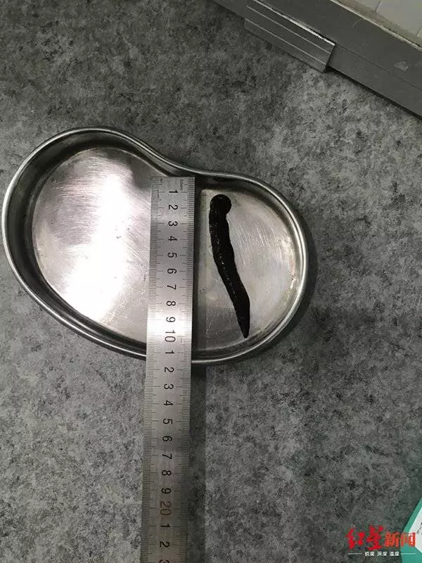 喉嚨藏10公分水蛭 麻醉後被醫生取出 !