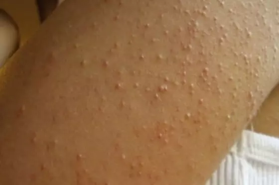如果你手臂上很常會出現類似像這樣的粉刺的紅點點的話,你就必須要停止吃「這些」東西!