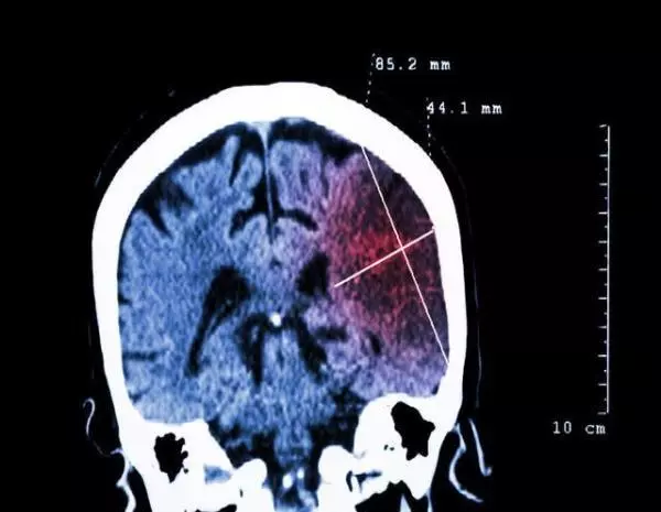 腦梗塞的病因,終於被揪出來了!這3個「禍源」最好遠離