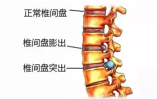 生娃後,為什麼媽媽們都喊「腰痛」?若你以為是「麻醉針」惹的禍,那就錯了!