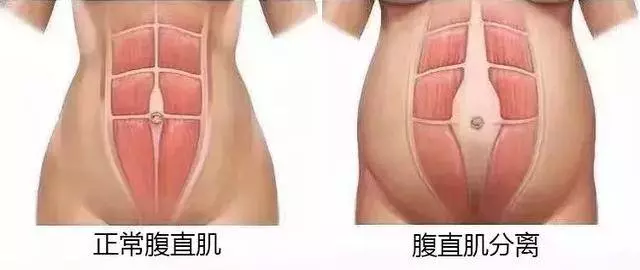 生娃後,為什麼媽媽們都喊「腰痛」?若你以為是「麻醉針」惹的禍,那就錯了!