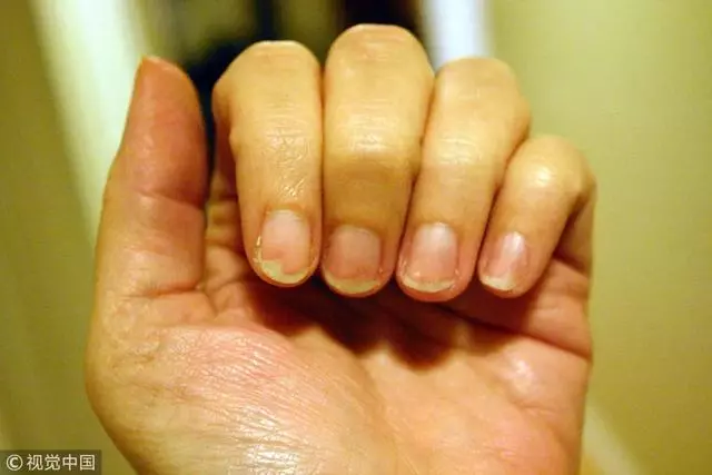 手上出現這6個變化,說明你的肝在「求救」!早發現才能早治療!