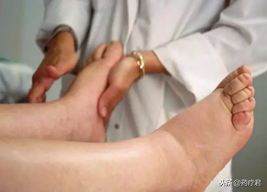 身體上不應該出現的「三道印兒」,若沒有,恭喜您很健康!