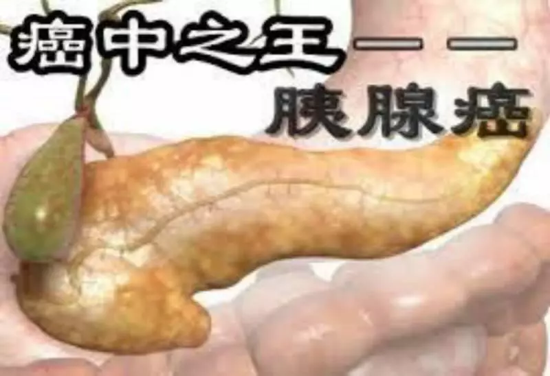 癌中之王-幾個壞習慣導致胰腺癌