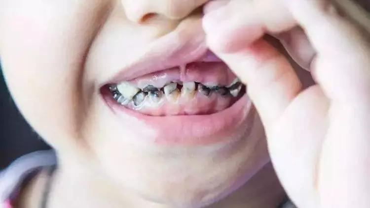 4歲女童一嘴小黑牙,兒科醫生:不是因為糖,而是家長的這種行為