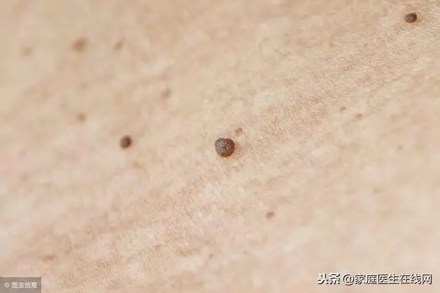 皮膚上的小肉疙瘩是什麼?醫生提醒:不出意外,就是這3種東西