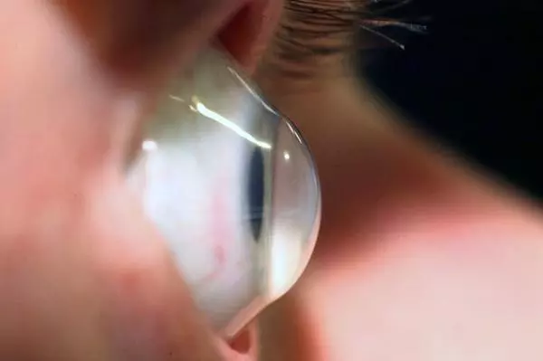 一篇文章詳解「近視眼雷射手術」,這些利弊你需要知道
