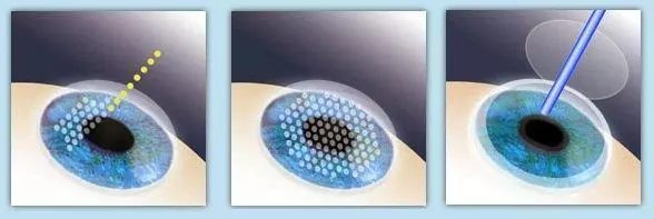 一篇文章詳解「近視眼雷射手術」,這些利弊你需要知道